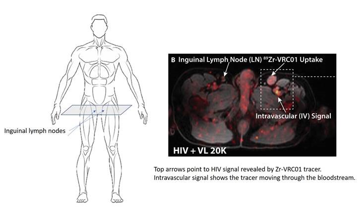 Using PET Scans To Visualize HIV AmfAR The Foundation For AIDS Research